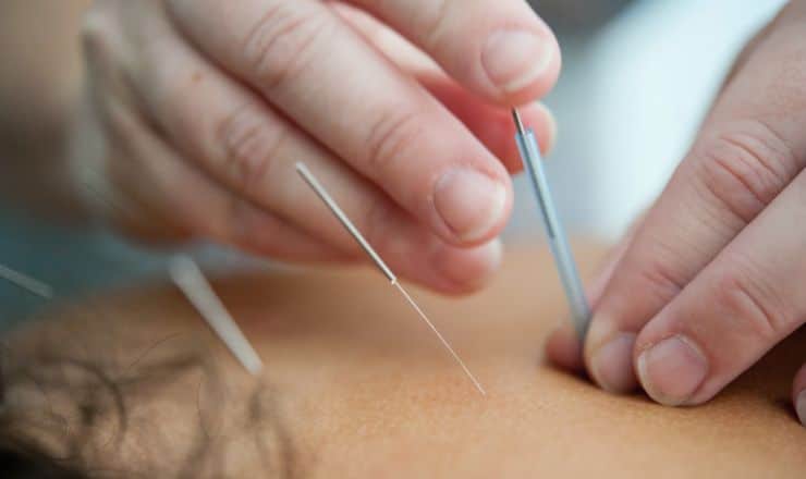 needling services at bowenhills acupuncture